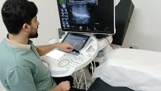 Scrotal Ultrasound  Hydrocele  microlithiasis [upl. by Hairu857]