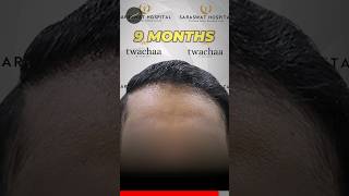 9 Months Hair Transplant Results 🔥 [upl. by Flynn]