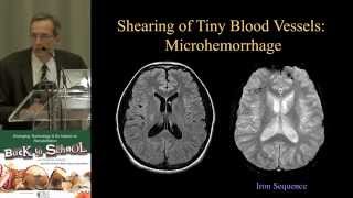 MRI of Truamatic Brain Injury by Dr David J Mikulis [upl. by Godden]