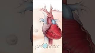 Cardiac Catheterization [upl. by Denae485]