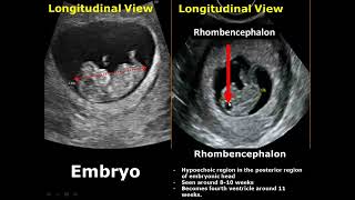 First Trimester amp Ectopic Pregnancy Ultrasound Image Appearances [upl. by Adlecirg]