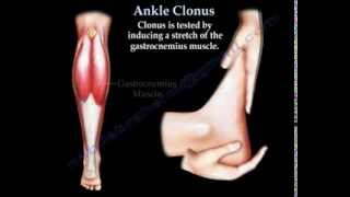 Ankle Clonus  Everything You Need To Know  Dr Nabil Ebraheim [upl. by Tina]