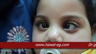 Nystagmus Blockage Syndrome  الرأرأة  العيون الراقصة [upl. by Knapp]