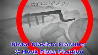 Crushed Clavicle End And Amazing Fix Hook Plate Solution [upl. by Hedvah]