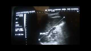 ultrasound SPLENIC HILAR REGION VARICES [upl. by Anoek]