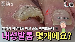 피부속에 박힌 내성발톱 어떻게 참으셨어요ㅠ 참다참다 방문하신 어르신 발톱 아프지 않게 관리해드렸어요 조원장의풋솔루션 레푸스상도점 문제성발관리 refuss 서울레푸스 [upl. by Firestone]