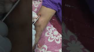 Birth Control implant Difficult removal of subdermal contraceptive implant [upl. by Faith574]