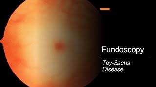 TaySachs Disease Fundoscopy [upl. by Disario]