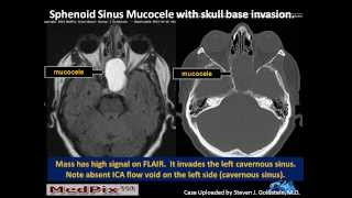 Sphenoid Sinus Mucous Retention Cyst vs Mucocele correction Slide 5 [upl. by Henrietta755]