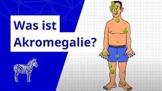 Was ist Akromegalie [upl. by Davie495]