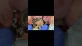 Proper Alveoloplasty  No gum shrinkage even after 2 years  Mandible full implants [upl. by Southard]