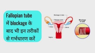 Fallopian tube blockage causes symptoms and treatment fallopiantubeblockage fallopiantube [upl. by Onailimixam]