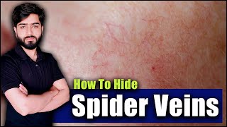 Spider Veins amp Redness Detailed Information  How To Fix Face Redness  Beauty Facts [upl. by Anilem]