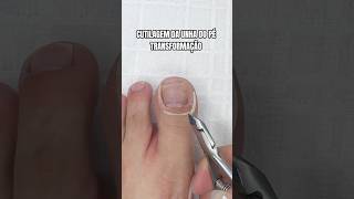 Transformação incrível da unha do pé 😍 pedicure manicure unhasdospés unhas pes [upl. by Brill]