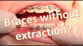 Nonextraction Orthodontics 2x4 Dgainer Mechanics [upl. by Saiff]