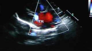 Hypoplastic Left Heart Syndrome [upl. by Nolur943]