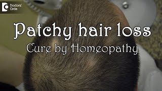 Homeopathic management of patchy hair loss  Dr Surekha Tiwari [upl. by Jarrell]