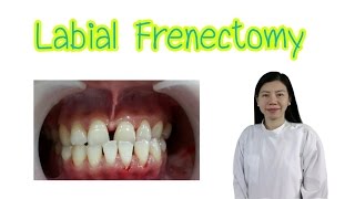 Labial frenectomy [upl. by Tarton4]