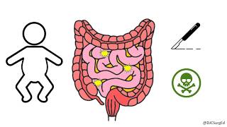 Necrotizing Enterocolitis [upl. by Felty]