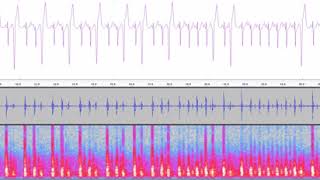 Hearbeat with 14 PVCs in half a minute [upl. by O'Gowan299]