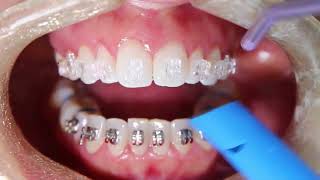 Clear Ceramic Braces [upl. by Rudolph]