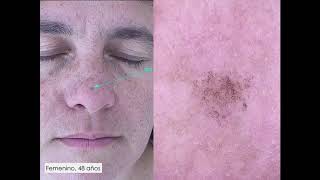 Lentigo maligno vs Pigmented actinic keratosis  Dra Rosario Peralta [upl. by Netnert431]