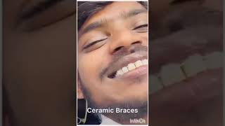 Ceramic Braces Treatment  Oasis Dental Care Chennai [upl. by Ayenat694]