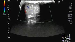 Ultrasound Video showing Testicular microlithiasis A rare case [upl. by Nmutua225]