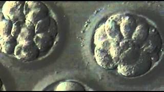 5Day Blastocyst Transfer [upl. by Halsey307]