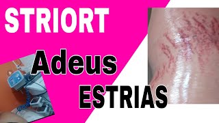 STRIORT PROCEDIMENTO PARA REMOVER ESTRIAS MINHA EXPERIÊNCIA INICIAL 1°sessão [upl. by Notanhoj]