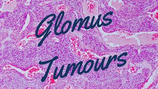 Glomus Tumours  Pathology mini tutorial [upl. by Emmi]