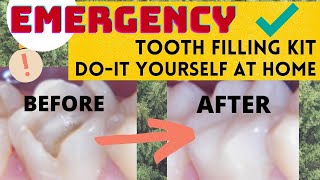 Emergency Tooth Filling Kit DIY at Home Easy Fix Solution [upl. by Id]