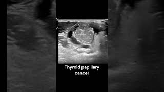 Thyroid Papillary Cancer ultrasound imaging radiology cancer endocrinology cases [upl. by Fein153]