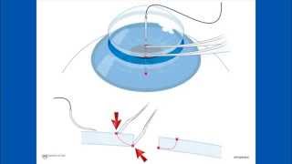 Corneal Suturing Part 2  Placing the Needle Into the Graft [upl. by Milstone714]