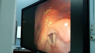 Bronchoscopy Video  How to Perform Bronchoscopy [upl. by Ahsinahs]