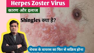 Herpes Zoster Shingles Disease Cause Symptoms and Treatment in Hindi  Varicella Zoster Virus [upl. by Mcevoy]