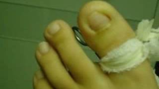 The Removal of an Ingrown ToeNail [upl. by Eseret601]