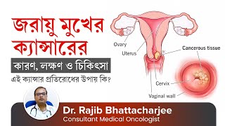 জরায়ু মুখের ক্যান্সারের কারণ লক্ষণ ও চিকিৎসা  Cervical Cancer Causes Symptoms amp Treatment [upl. by Bennett]