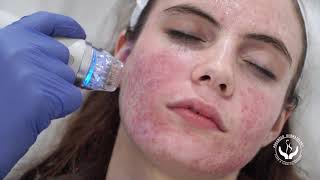 Secret RF Microneedling with RF [upl. by Bac]