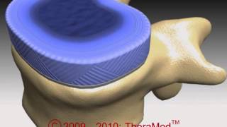 How a disc gets damaged cause and cure for slipped disc AKA slip disc [upl. by Wadell]