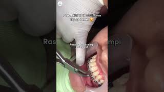 Gigi rapih tuh emang bisa bikin naikin mood everyday gak sih Bawaannya mau senyum terus 😍 braces [upl. by Oecam645]