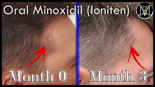 Oral Minoxidil Loniten Result in 3 months [upl. by Reisch]