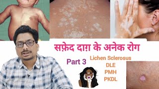 सफ़ेद दाग़ के अनेक रोग  Part 3  White Spots in Adults amp Elderly  Lichen Sclerosus DLE PKDL PMH [upl. by Chil]