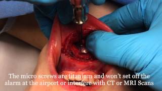 Silicone Chin Implants Made Easy Intraoral Approach inside the mouth by Dr Joe Niamtu III [upl. by Leilani]