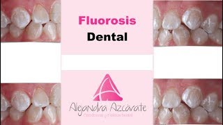 Fluorosis Dental  Alejandra Azcárate [upl. by Mehelhteb]