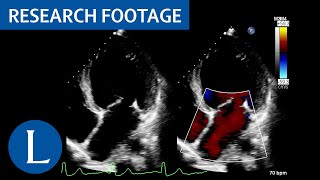 Dilated left ventricle with global hypokinesia LibmanSacks endocarditis 1 of 4 [upl. by Anitrak]