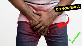 An Overview of Gonorrhea Symptoms Causes and Treatment Options [upl. by Cami]