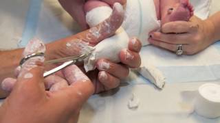 Club Foot  Akron Childrens Hospital video [upl. by Soilissav626]