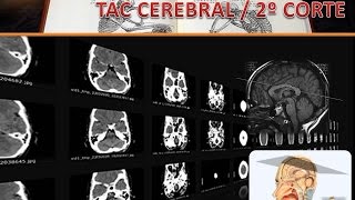 TAC CEREBRAL VIDEO 2 CORTE 2 [upl. by Arramat301]