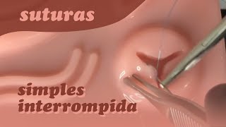 Incisão em Y  Sutura Simples Interrompida [upl. by Nnitsuj]